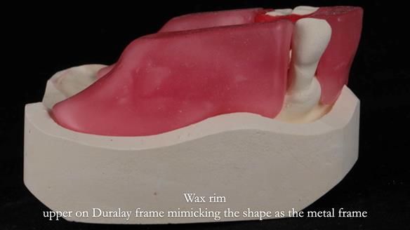 Finlay's Newsletter 59 Ultra hard partial dentures made for Gill