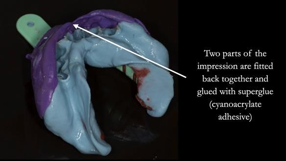 Finlay's Case Study Newsletter 40 - Immediate Mk 1 RPD to Definitive Mk 2 RPD - full protocol
