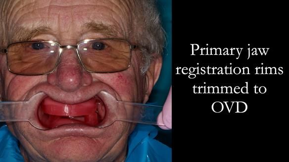 Complete denture Class II div 2 deep overbite Newsletter 39