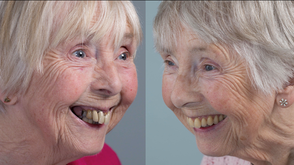 Figure 105 Comparison of natural teeth and Mk 2 complete upper denture