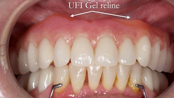 Newsletter 52 Managing Jo’s failing dentition with extractions and Mk 1/Mk 2 complete upper dentures and lower partial dentures FULL PROTOCOL