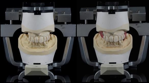 Newsletter 56 showing the making and fitting of a bilateral free end saddle upper removable partial denture (RPD) for patient with pemphigus