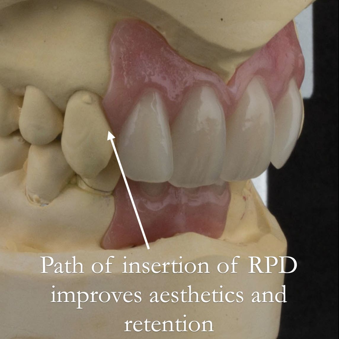 Path of insertion for partial dentures