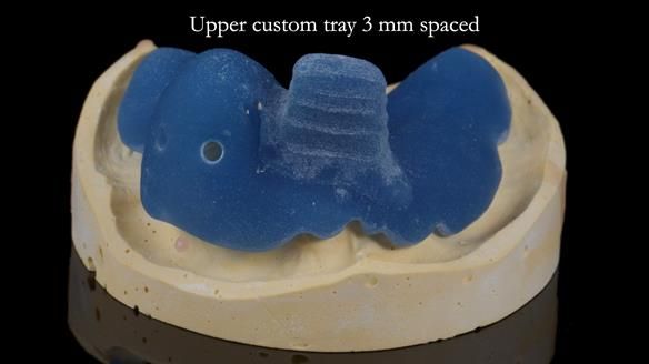 Newsletter 55 Provision of metal based partial dentures for Zephyrine with a repaired cleft lip and palate