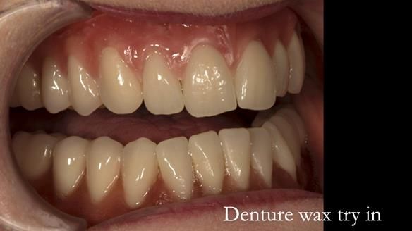 Newsletter 75: Marion’s case - Step-by-step complete denture workflow