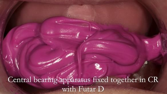 Newsletter 75: Marion’s case - Step-by-step complete denture workflow