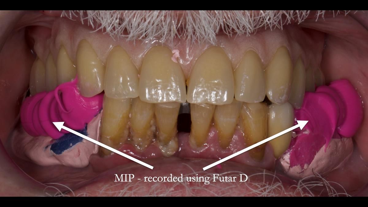 Newsletter 87 – Father Peter: A Partial Denture that needed Minor Miracle