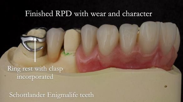 Eileen's transformation with upper and lower RPDs of Scandinavian hygienic design FULL PROTOCOL