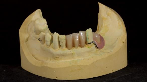 Newsletter 86 Peter the Architect — precision removable partial dentures case study