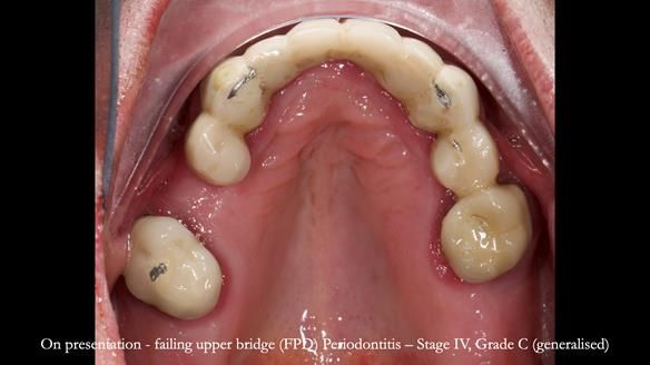 Newsletter 77: Jeremy’s case – immediate complete upper denture