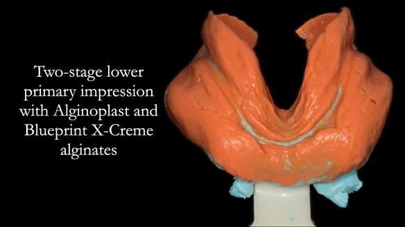 Newsletter 75: Marion’s case - Step-by-step complete denture workflow