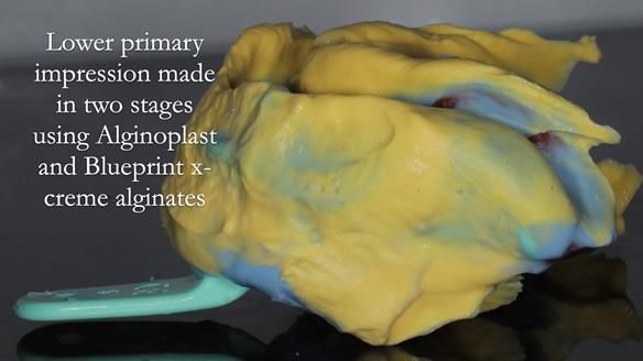 Finlay's Newsletter 61 provision of a lower unilateral free end saddle metal based partial denture for Joyce