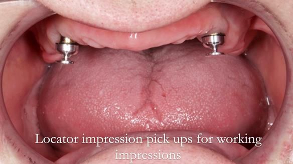 Newsletter 57 showcases the making and fitting process of implant-supported complete dentures for Alisdair