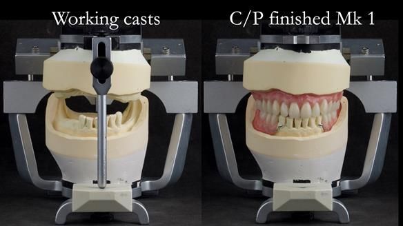 Newsletter 52 Managing Jo’s failing dentition with extractions and Mk 1/Mk 2 complete upper dentures and lower partial dentures FULL PROTOCOL