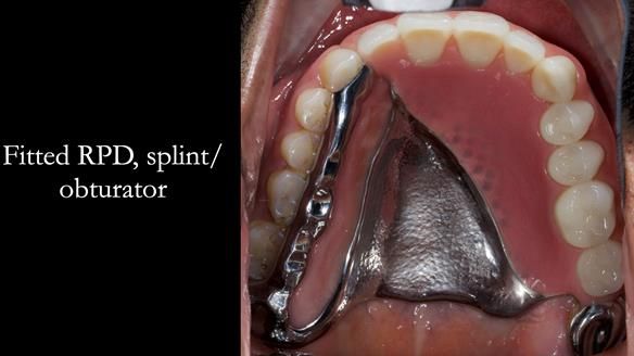 Upper metal base partial denture/occlusal stabilisation splint/obturator - full protocol