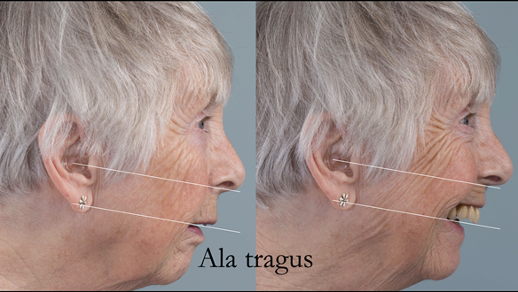 Figure 106 From the side view the occlusal plane is carved parallel with the ala-tragal line (Camper’s plane) as this is approximately parallel with the occlusal plane in fully dentate people