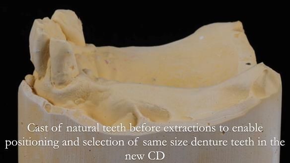 Finlay's Newsletter 62 provision of extractions and metal based complete dentures for Rafique