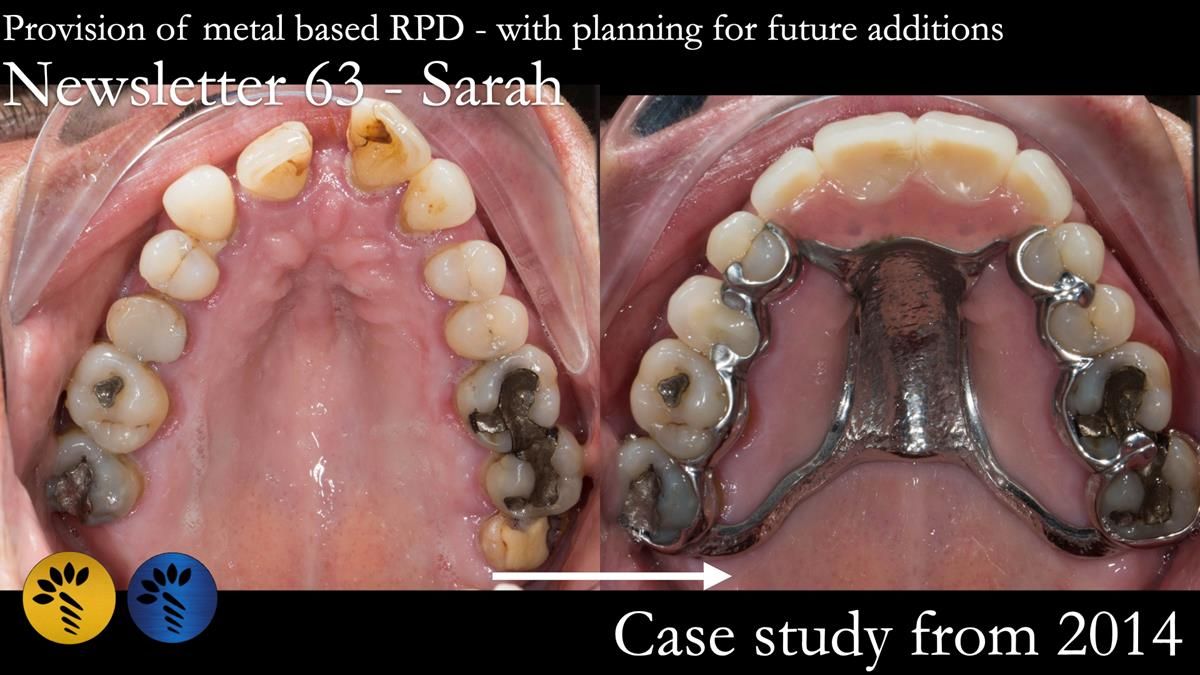 Finlay's Newsletter 63 Case study provision of metal based Scandinavian RPD - functional 10 years on