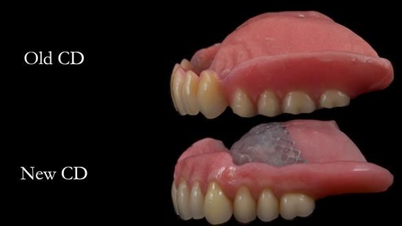 Finlay's Newsletter 62 provision of extractions and metal based complete dentures for Rafique