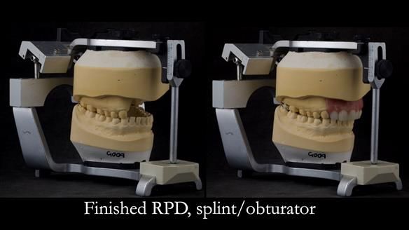 Upper metal base partial denture/occlusal stabilisation splint/obturator - full protocol