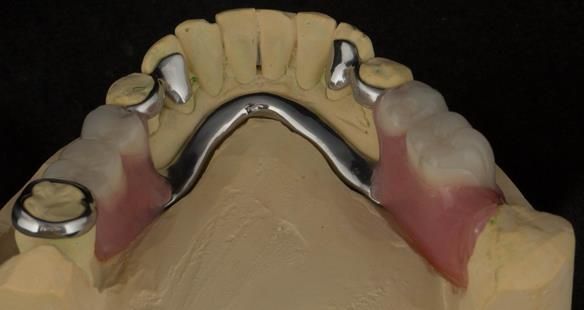 Figure 82 Finished definitive partial denture. Scandinavian design with sublingual bar - keeping the denture components 3mm away from the gingival margin