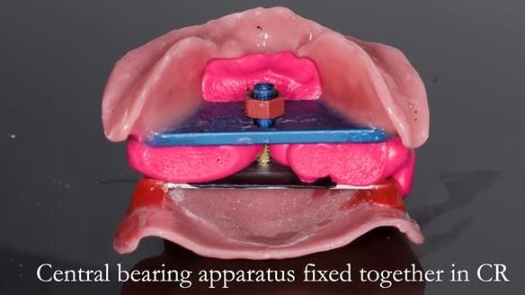 Managing poor implant positioning with complete dentures and Locator attachments - full protocol Newsletter 41