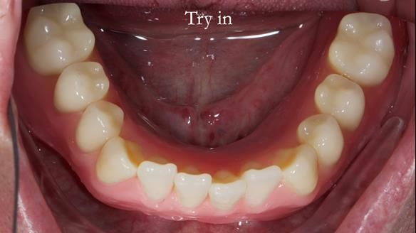 Newsletter 57 showcases the making and fitting process of implant-supported complete dentures for Alisdair