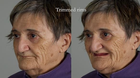 Newsletter 83: Sheila’s Complete Denture Success