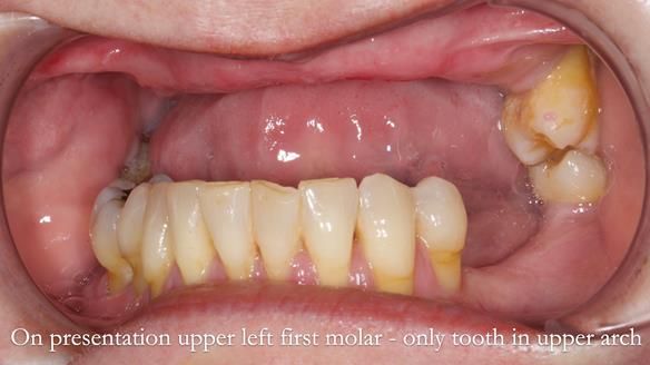Finlay's Newsletter 58 Gasket upper partial denture for Zoe