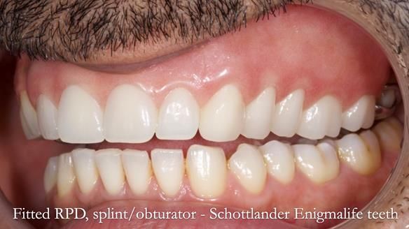 Upper metal base partial denture/occlusal stabilisation splint/obturator - full protocol