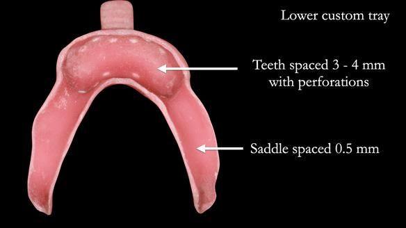 Newsletter 52 Managing Jo’s failing dentition with extractions and Mk 1/Mk 2 complete upper dentures and lower partial dentures FULL PROTOCOL