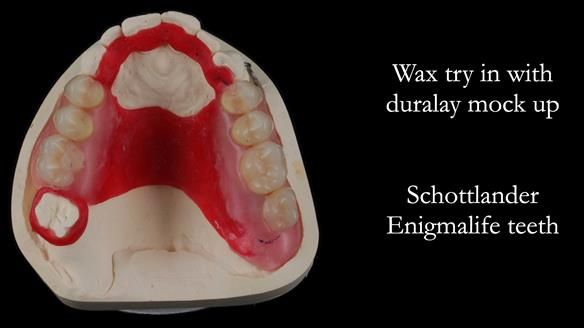 Finlay's Newsletter 60 Sylvia's upper Kennedy Class 2 Mod 1 metal based upper RPD