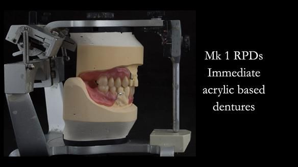 Finlay's Case Study Newsletter 40 - Immediate Mk 1 RPD to Definitive Mk 2 RPD - full protocol