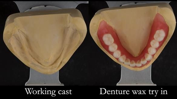 Newsletter 75: Marion’s case - Step-by-step complete denture workflow