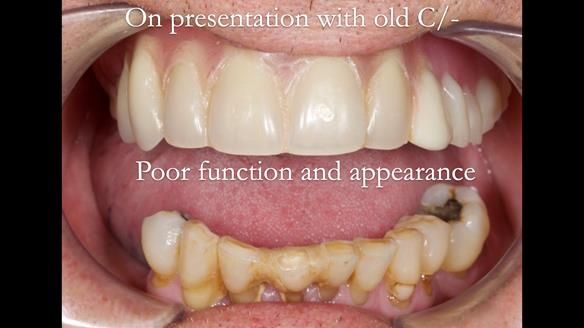 Newsletter 54 case presentation upper complete denture and lower Scandinavian designed hygienic partial denture for David