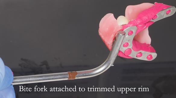 Newsletter 55 Provision of metal based partial dentures for Zephyrine with a repaired cleft lip and palate