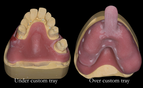 Figure 14 Custom trays for the definitive impression, allowing impression making without the teeth "getting in the way". The under tray is for the edentulous parts. The over tray records the teeth.