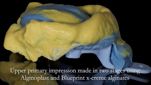 Newsletter 52 Managing Jo’s failing dentition with extractions and Mk 1/Mk 2 complete upper dentures and lower partial dentures FULL PROTOCOL