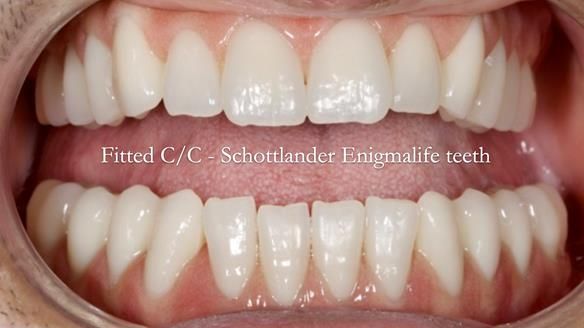 Managing poor implant positioning with complete dentures and Locator attachments - full protocol Newsletter 41