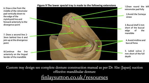 Newsletter 80 - Gordon’s dentures: the one case in 1,000 where my technique failed
