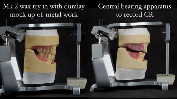 Finlay's Case Study Newsletter 40 - Immediate Mk 1 RPD to Definitive Mk 2 RPD - full protocol