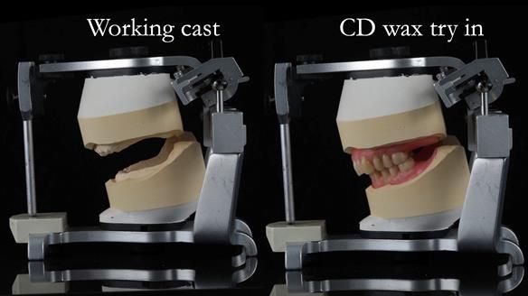 Finlay's Newsletter 62 provision of extractions and metal based complete dentures for Rafique