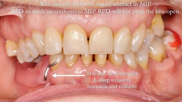 Finlay's Newsletter 61 provision of a lower unilateral free end saddle metal based partial denture for Joyce