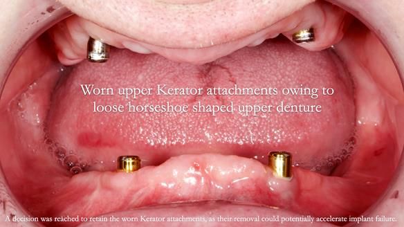 Newsletter 57 showcases the making and fitting process of implant-supported complete dentures for Alisdair