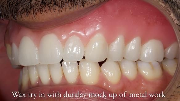 Upper metal base partial denture/occlusal stabilisation splint/obturator - full protocol