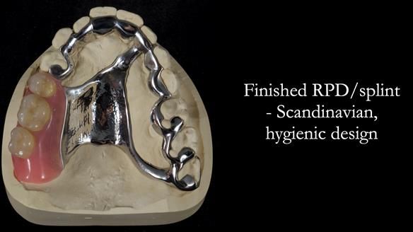 Finlay's Newsletter 64 case study - provision of a Kennedy class 2 metal based Scandinavian RPD for Ian