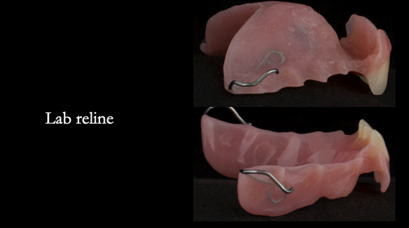 Figure 49 Immediate denture laboratory relined - this improves aesthetics and retention