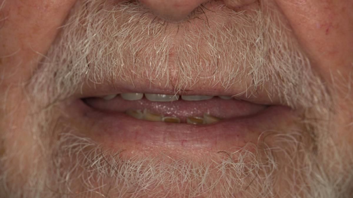 Newsletter 87 – Father Peter: A Partial Denture that needed Minor Miracle
