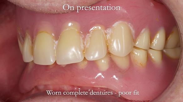 Newsletter 57 showcases the making and fitting process of implant-supported complete dentures for Alisdair