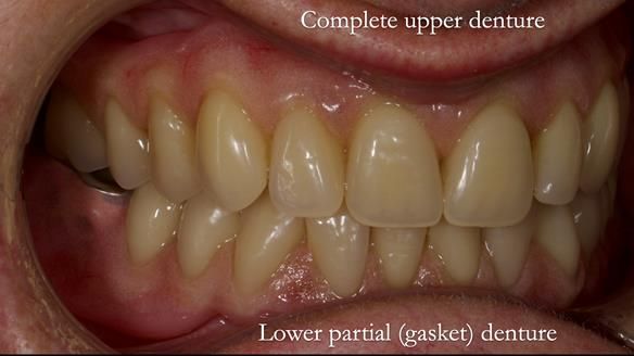 Newsletter 82 Mary - A complete upper and a one-tooth gasket denture